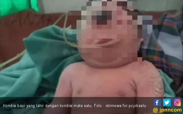 Heboh, Ada Bayi Lahir dengan Hanya Satu Mata di Keningnya