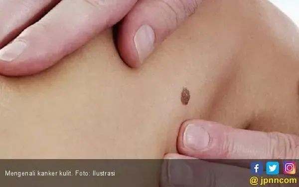 Tingkat Kematian karena Kanker Kulit Melonjak, Kebanyakan para Pria