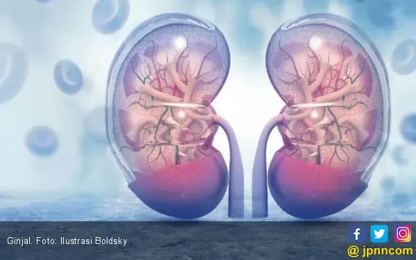 Gagal Ginjal, Pasang CAPD atau Transplantasi?