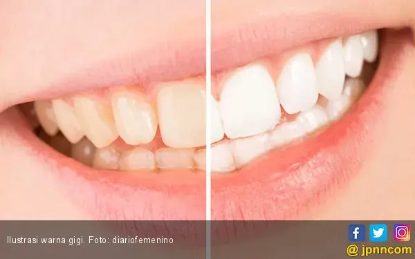 Tiga Risiko Pasang Veneer Gigi