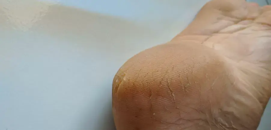 Tiga Kiat Memilih Alas Kaki Untuk Kaki Pecah-pecah