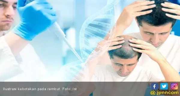 Ini Penyebab Tersering Rambut Mudah Rontok
