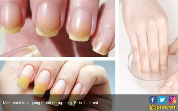 Langkah Sederhana Mengatasi Kuku Kuning