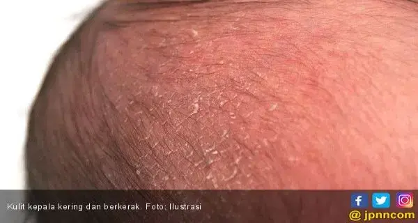 Atasi Kulit Kepala Kering dengan 3 Ramuan Ini