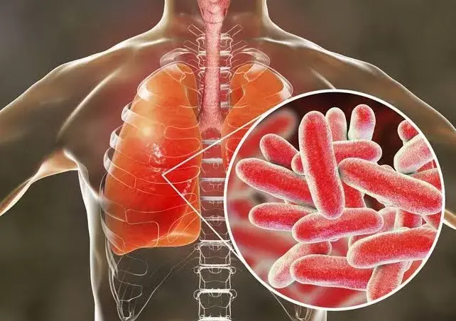 Lansia Paling Rentan Terjangkit Bakteri Legionellosis