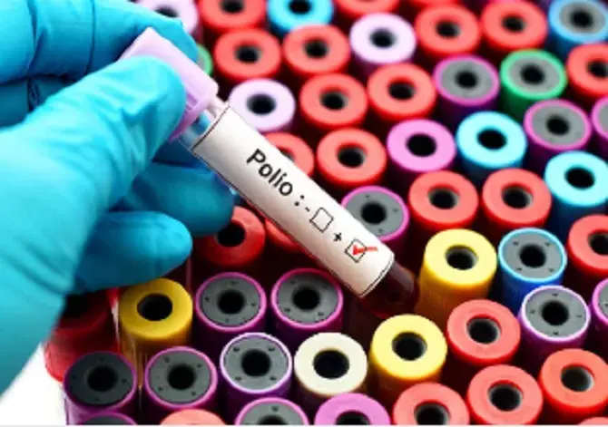 New York Darurat Polio, Virus Meluas Ancam Kelumpuhan